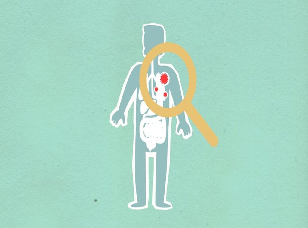 Gasteromaradical Disease